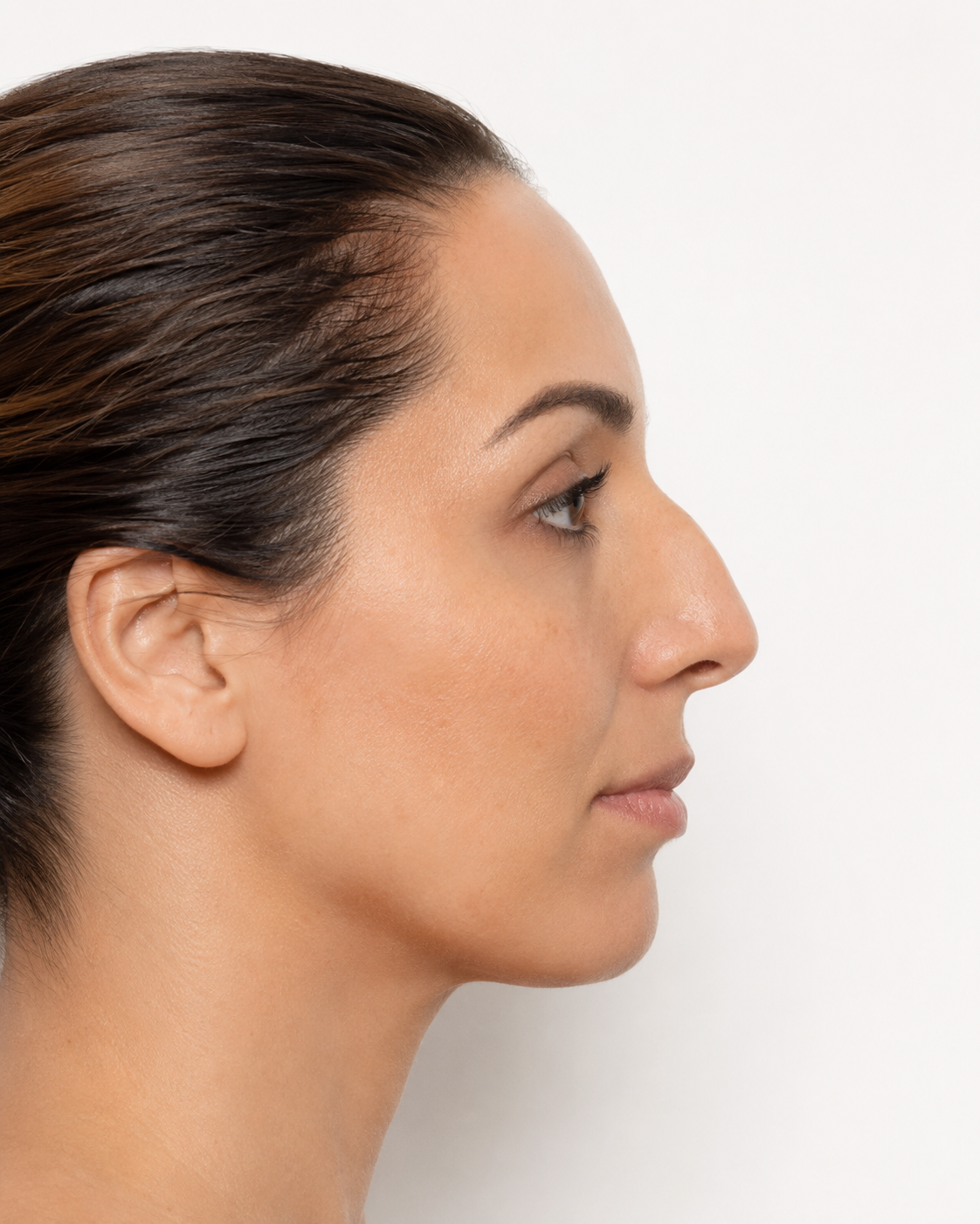 Before rhinoplasty nasal refinement